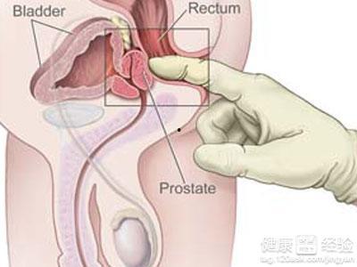 女大夫前列腺按摩视频,前列腺按摩实操教学视频解析